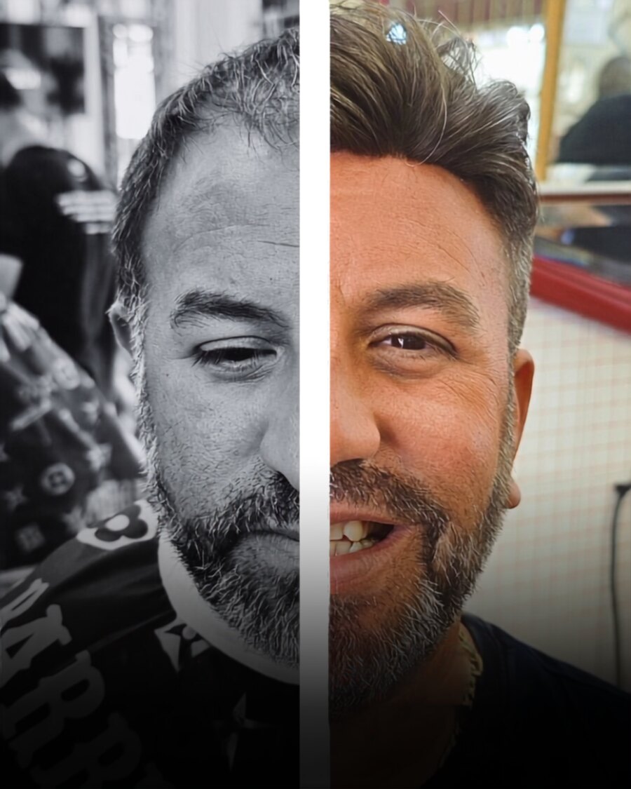 Antes y después de una prótesis capilar en Procabe, cliente de Alicante